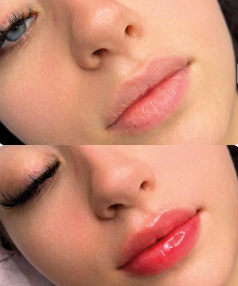 Ácido Hialurónico resultado 1