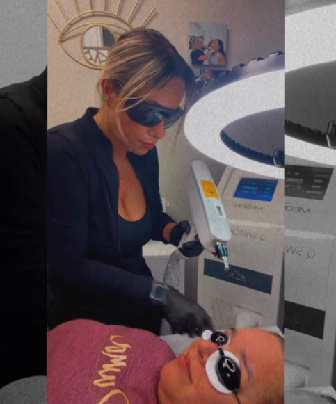 Eliminación Láser resultado 1