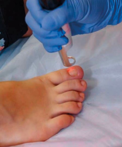 Tratamiento Láser resultado 1